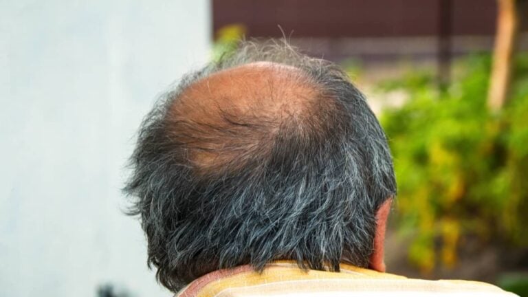 Homem calvo - tanitost / shutterstock.com
