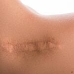 Ombro de mulher, cicatriz - privetik/ istockphoto.com