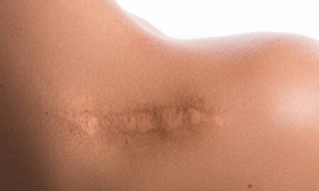 Estudo na Nature revela que pele feminina cicatriza mais rápido