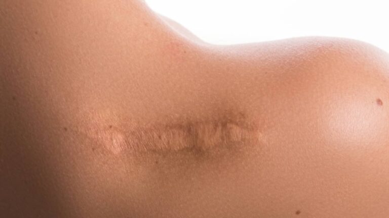 Ombro de mulher, cicatriz - privetik/ istockphoto.com