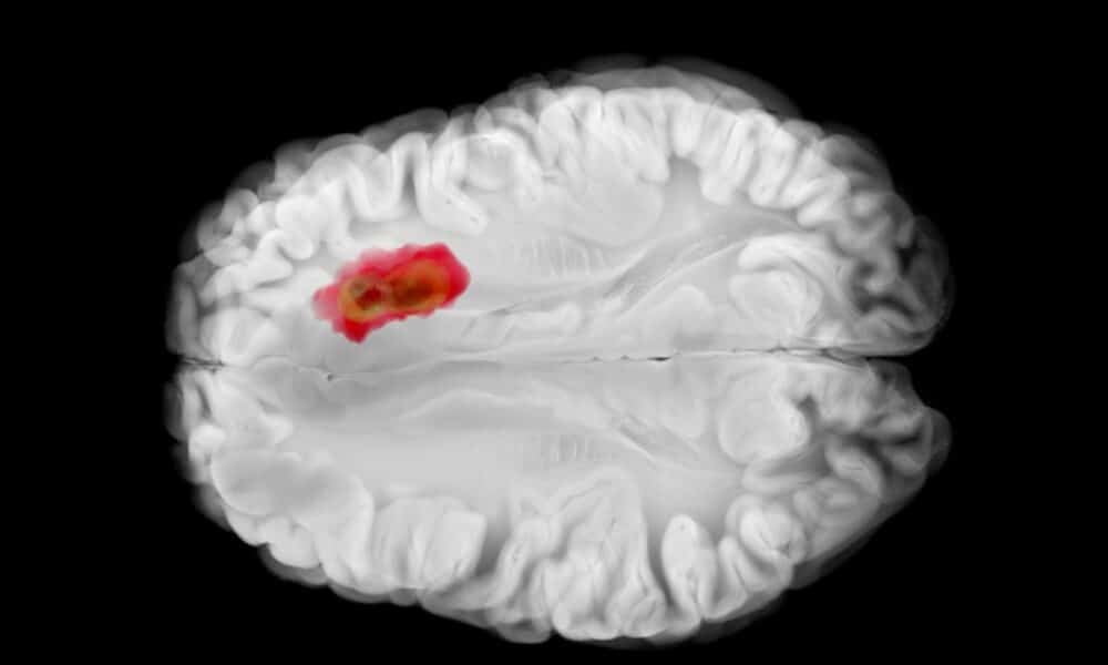 Sinais de tumor cerebral que costumam passar despercebidos