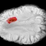 Tumor cerebral - VisualMediaHub - shutterstock.com