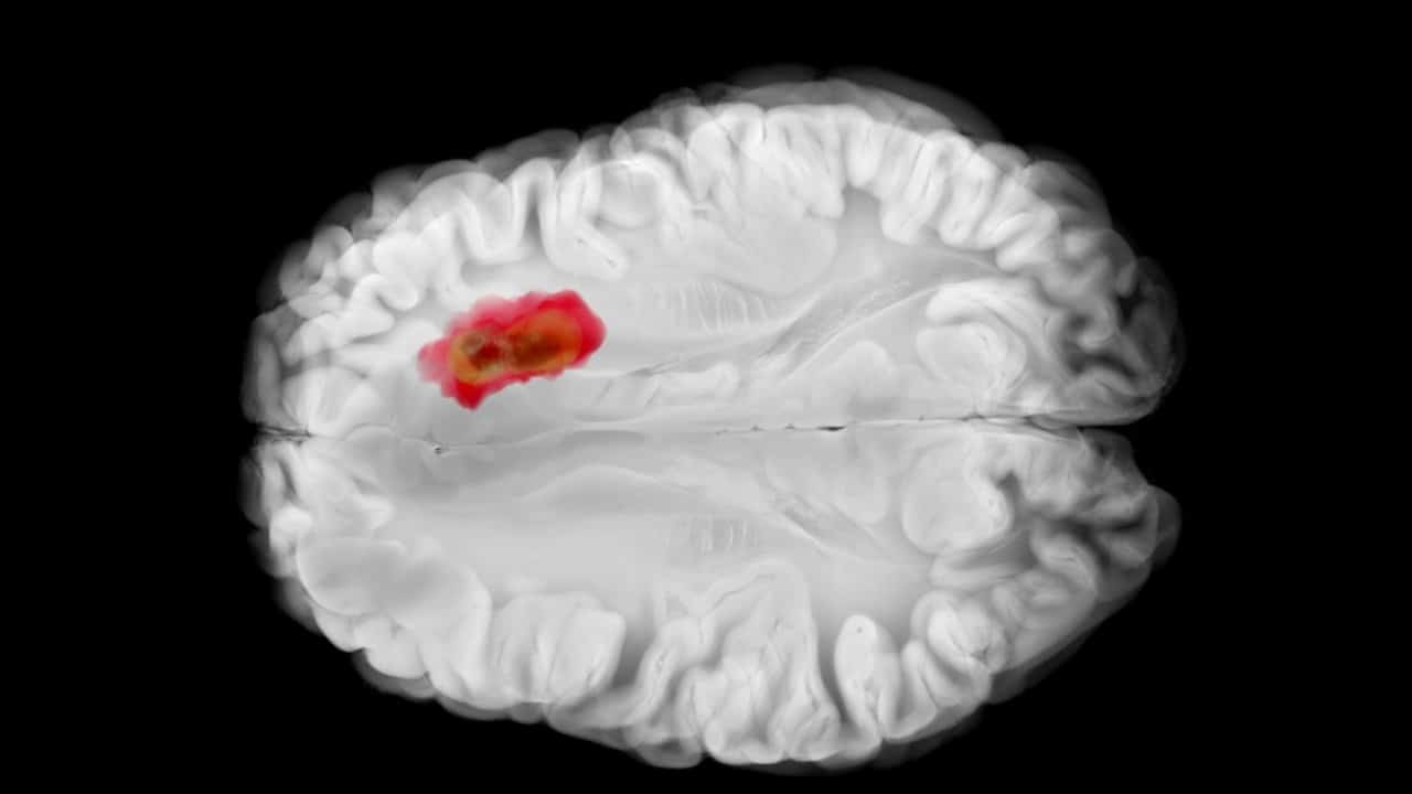 Tumor cerebral - VisualMediaHub - shutterstock.com